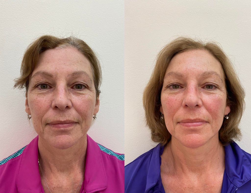 Cosmetic acupuncture before and after photos: Front view. Overall brighter skin, reduced fine lines between brows and at the outside of the eyes.