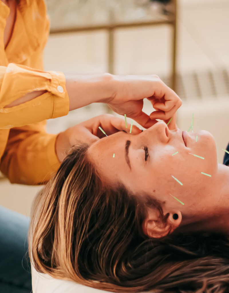 Patient resting peacefully during cosmetic acupuncture treatment at Seneca Falls Acupuncture.