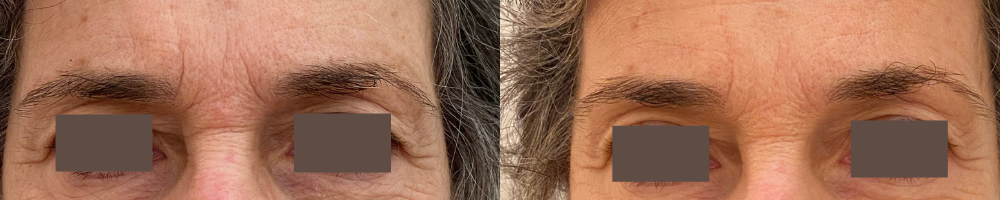 Close up view of cosmetic acupuncture before and after results on lines between the brows and on forehead, showing softened fine lines and wrinkles. Photos taken at Seneca Falls Acupuncture and shared with permission.