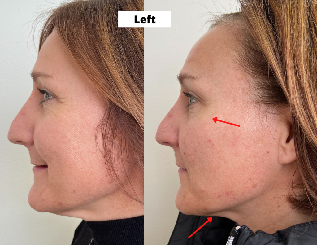 Left side before and afters from 10 cosmetic acupuncture treatments showing reduced crow's feet and tightening under the jawline.