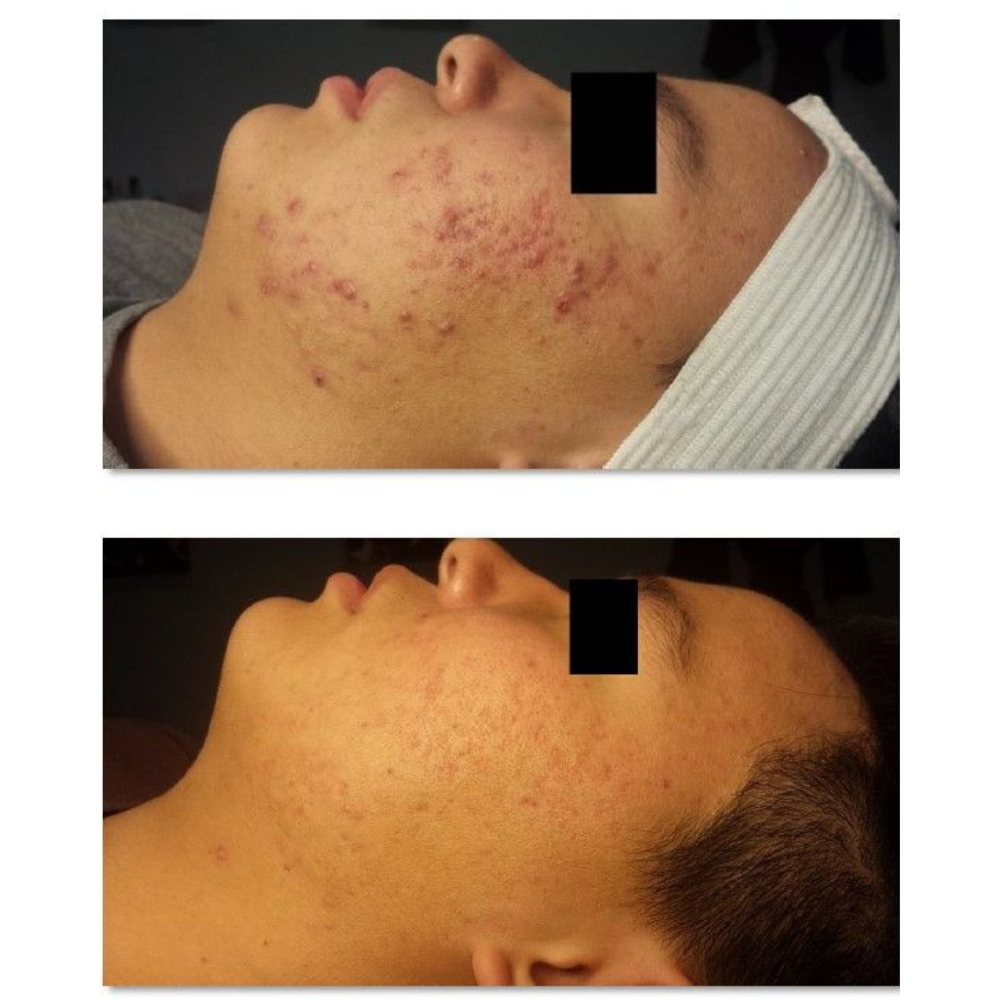 Before and after photos of significantly reduced cystic acne after using Celluma LED Light therapy.