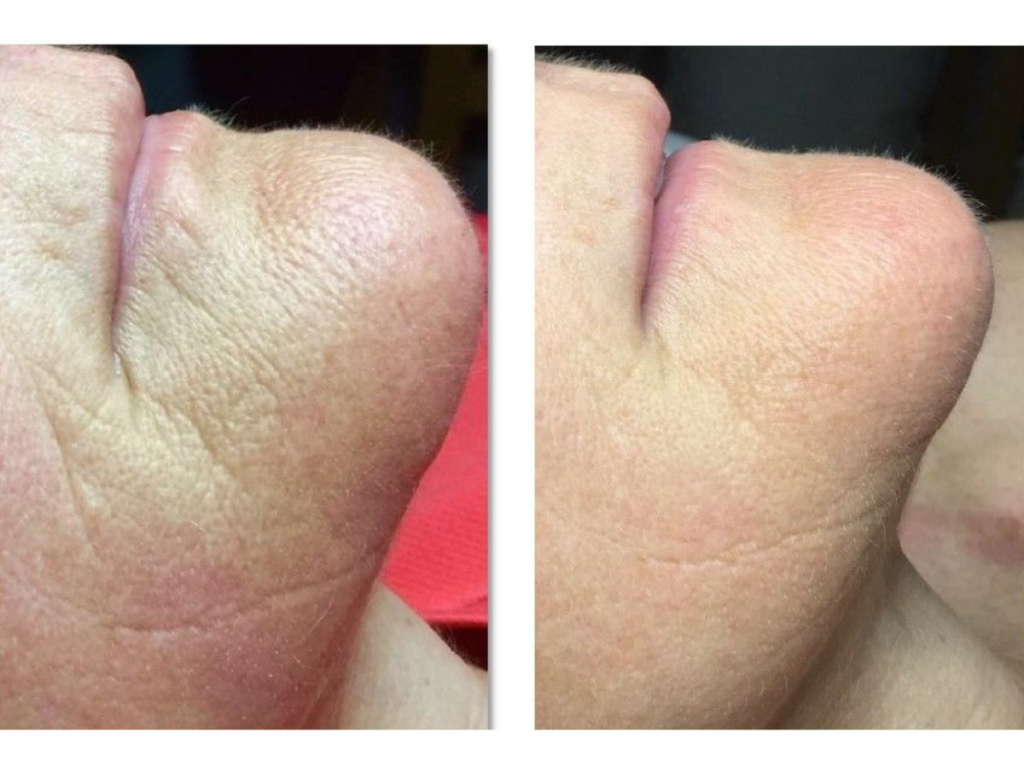 Before and after Celluma LED Light therapy at Seneca Falls Acupuncture showing reduced wrinkles and lines in the chin.