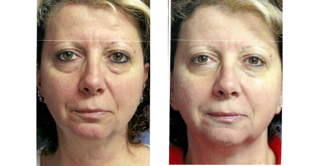 Before and after photos from 10 cosmetic acupuncture treatments at Seneca Falls Acupuncture.
