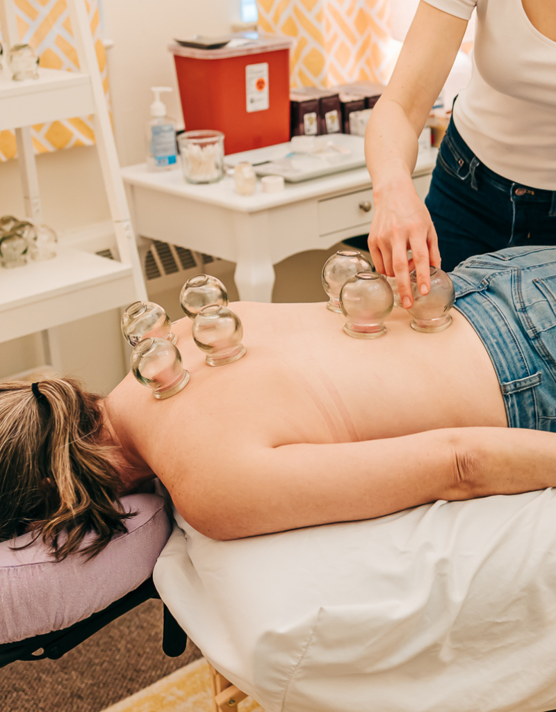 Patient at Seneca Falls Acupuncture relaxing while getting cupping on her lower and upper back to relieve tight, sore, overused muscles.