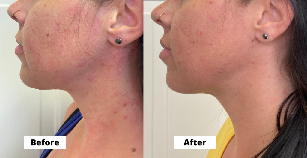 Acne before and after photos, left side of the face.